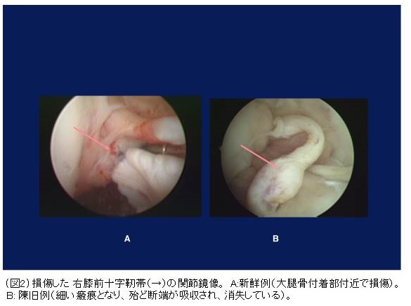 膝の靱帯手術を受けられる患者様へ | 診療科・部門 | 社会医療法人 行