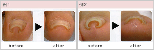 巻き爪ケア（ドイツの巻き爪ケア法「B/Sスパンゲ」）｜浦和美園駅前