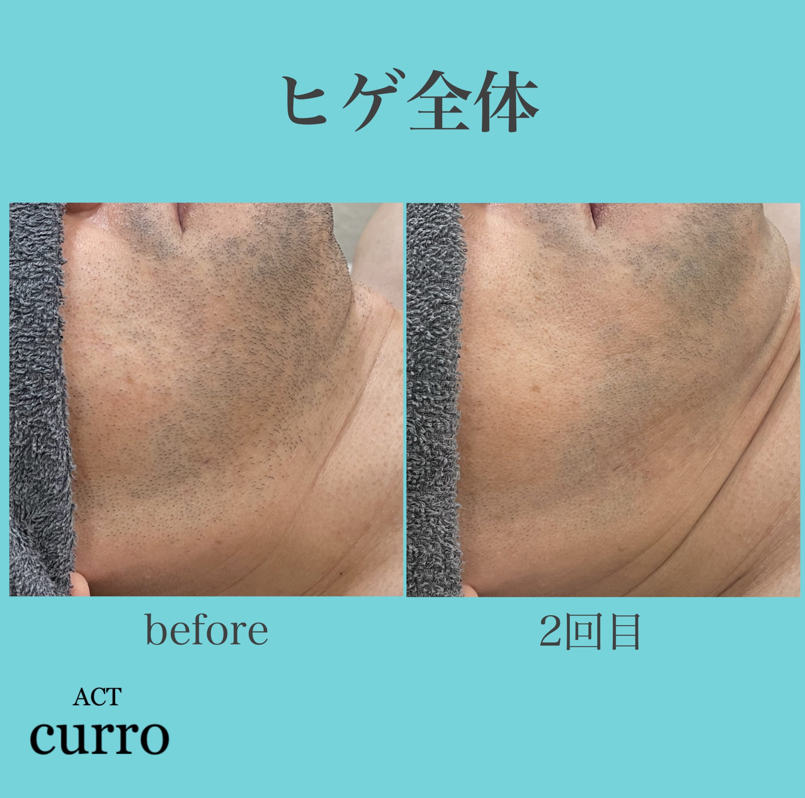 ヒゲ脱毛 2回目照射後1ヶ月後 – ACT CURRO（アクト クロ）