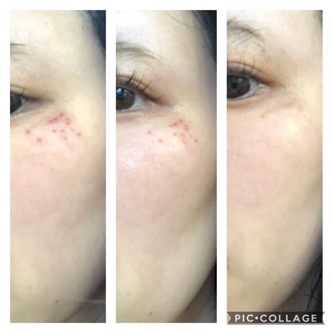 注目の低周波ペンシルのシミケア効果を解説｜従来のシミケア方法と比較