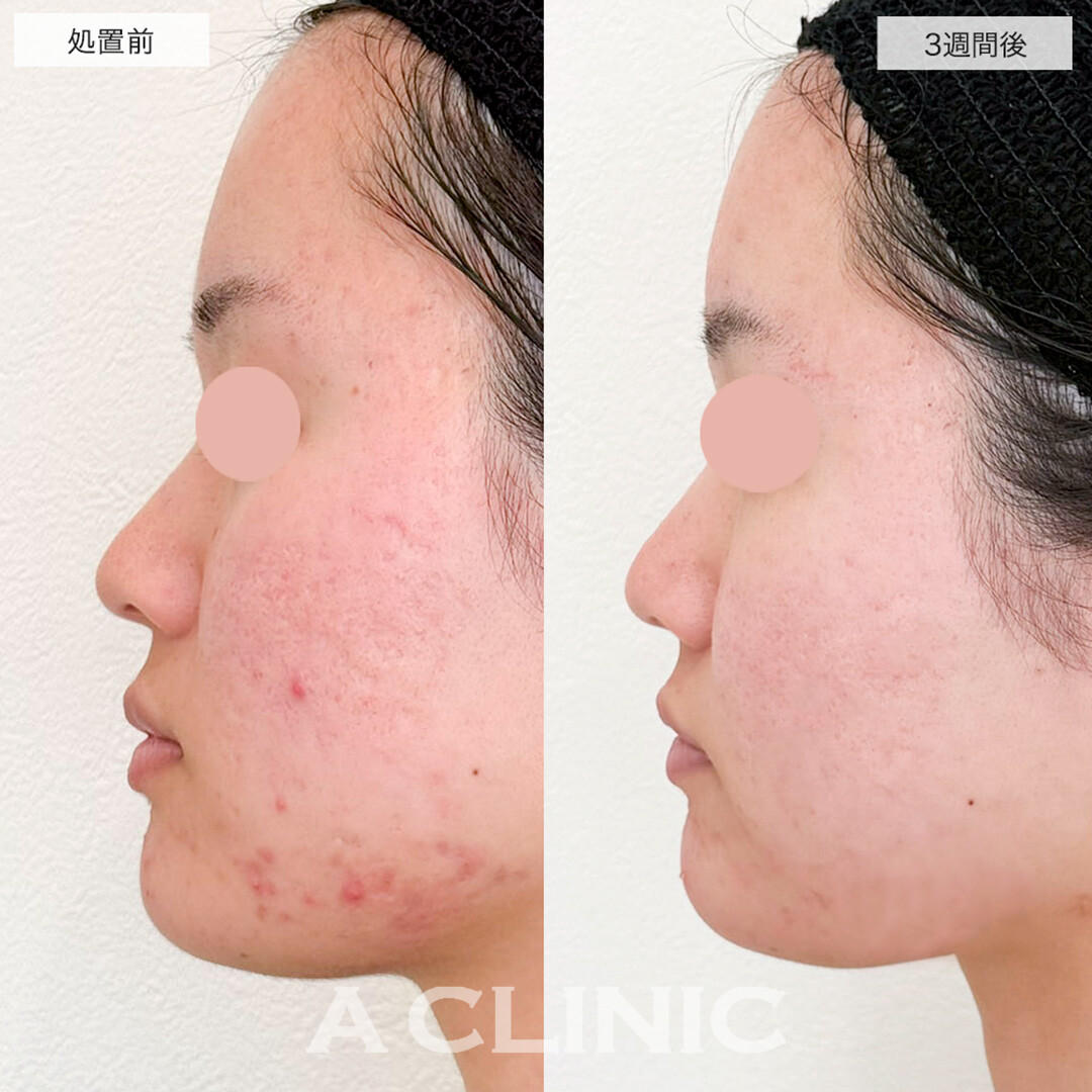 手打ち水光注射でハリのある肌に！処置前と1週間後の症例です(20代女性