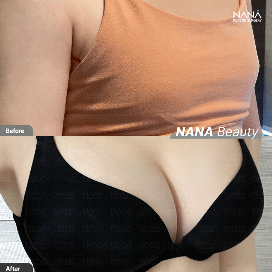 豊胸手術は10年後に再手術が必要！？｜韓国整形NANA美容外科