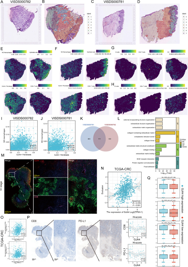GJA4 expressed on cancer associated fibroblasts (CAFs)—A 'promoter