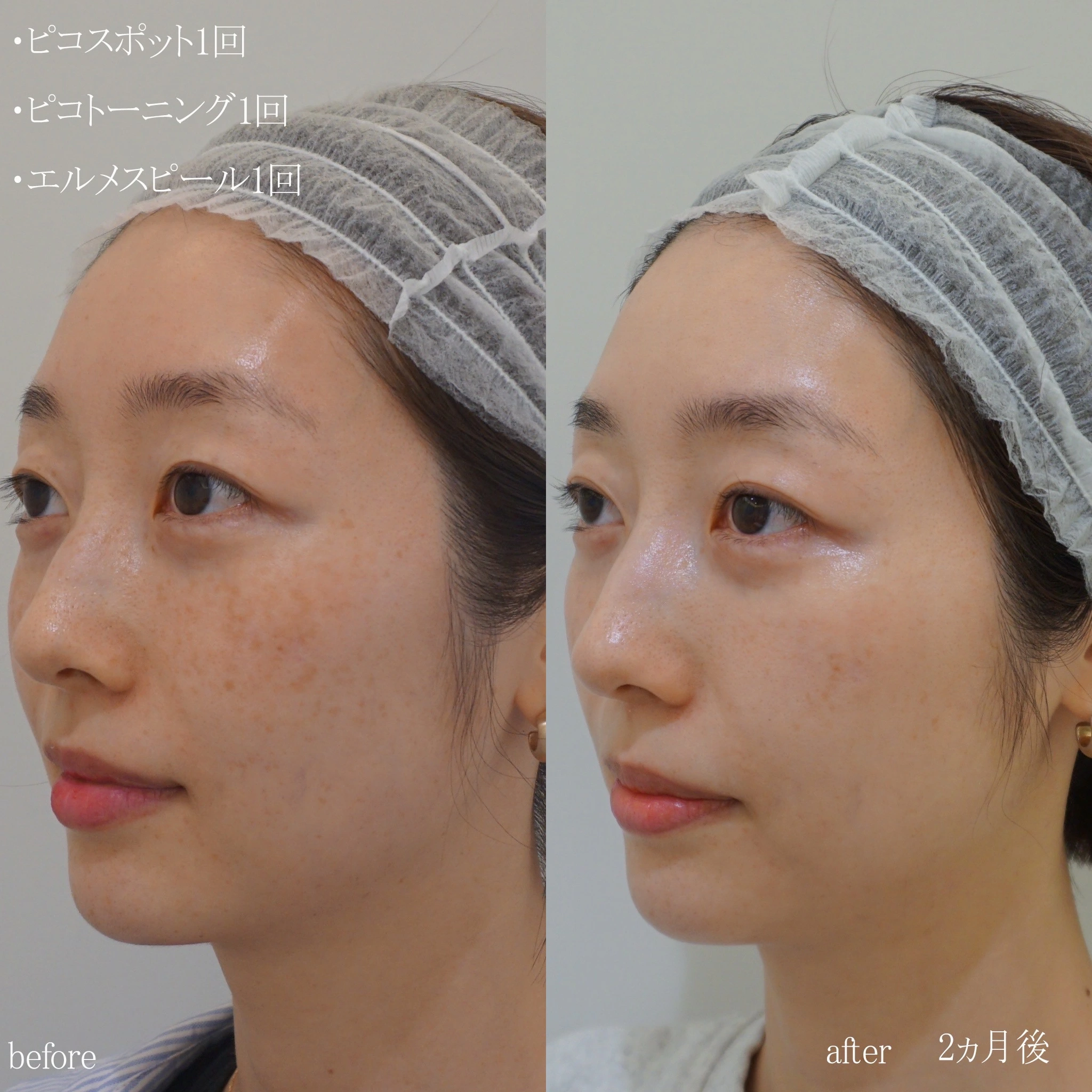 日焼けのシミを消す方法は？シミの原因と対処法を美容皮膚科医が解説