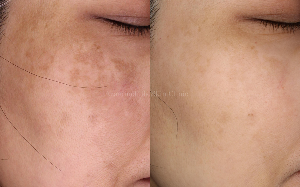 進化したエレクトロポレーション デルマシオ｜