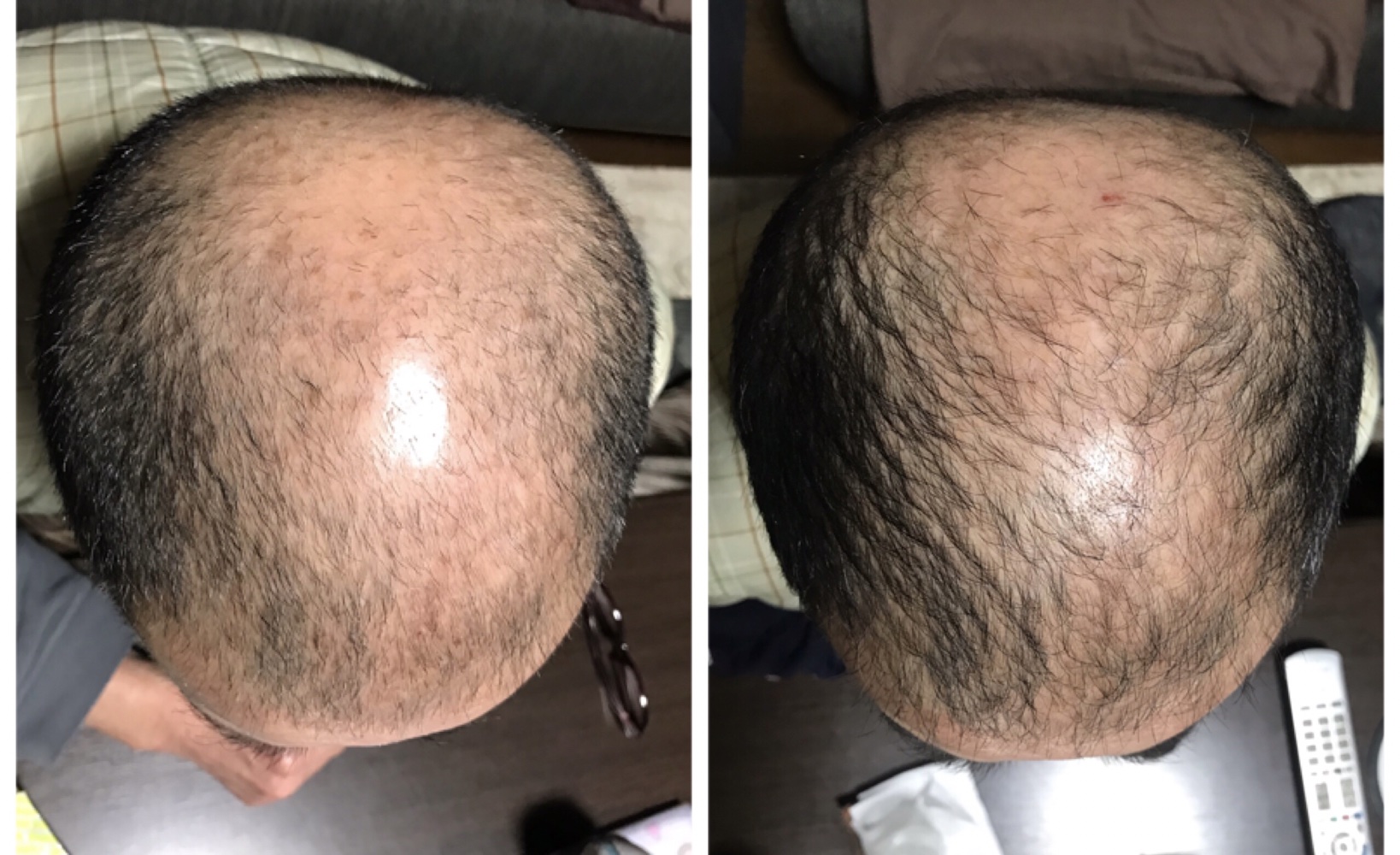 お家でプラズマフェイシャル！？育毛、発毛、白髪改善も！？『プラズマ