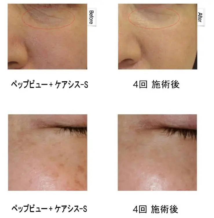 エレクトロポレーション治療 | Beauty Tuning Clinic