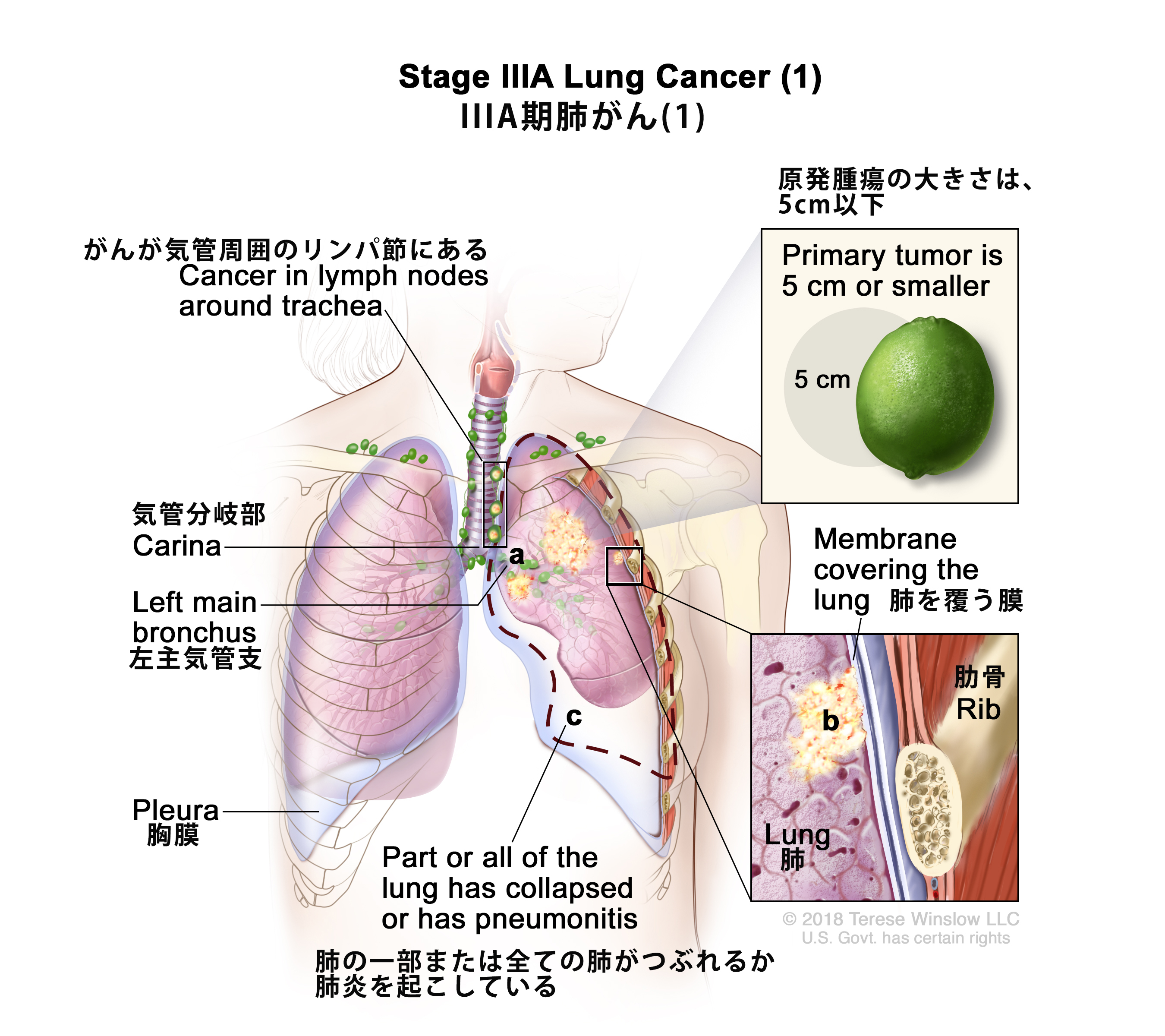 がん情報サイト | がん情報各論：[医療専門家向け]非小細胞肺がんの