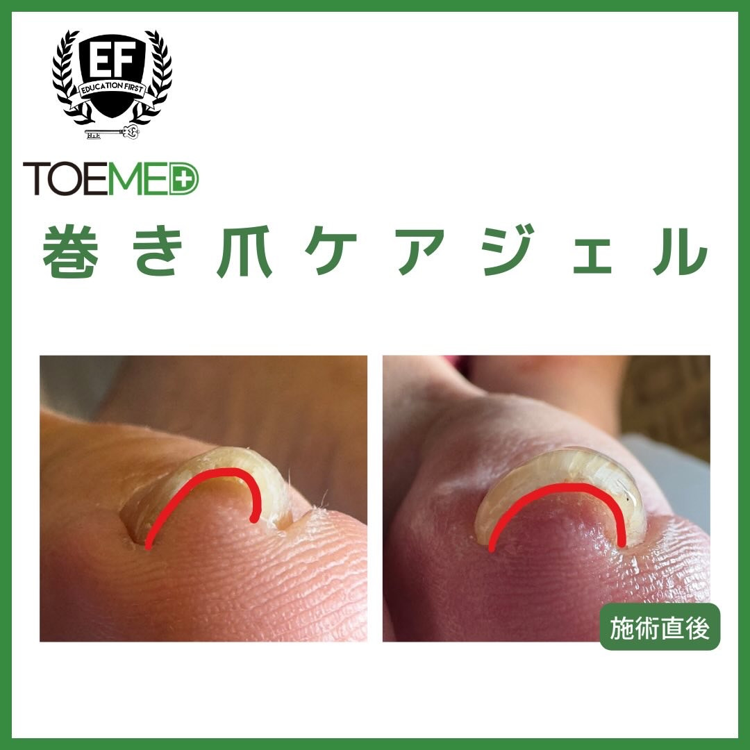 TOEMED 巻き爪ケア 3点セット TOEMED 3本セット (TOME-SET)｜BEAUTY NAILER