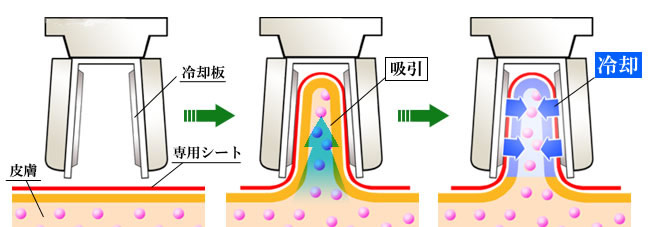 冷却痩身クライオ・リポライシス｜クリニーク大阪心斎橋本院・梅田院