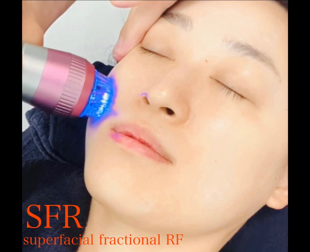 たるみ改善・リフトアップ・小顔(USL×SFR)) | パンダ整骨院