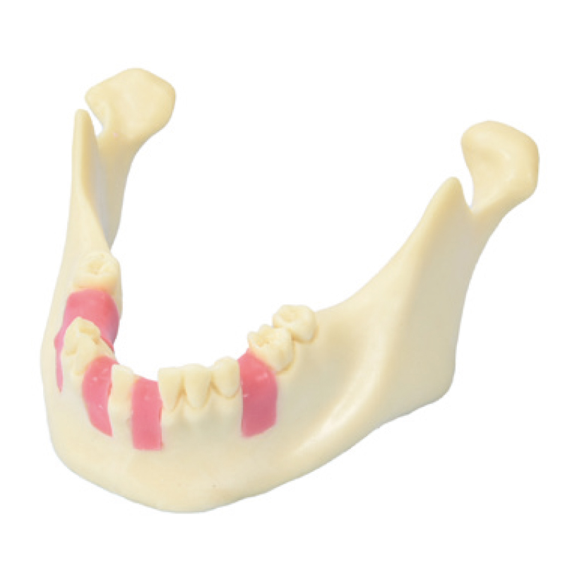 インプラント実習用模型 歯肉付きインプラント埋入下顎模型の通販 | Ci