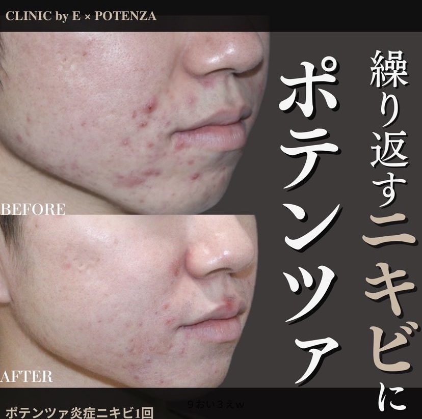 繰り返すニキビ・大量発生するニキビポテンツァ - イーメディカル