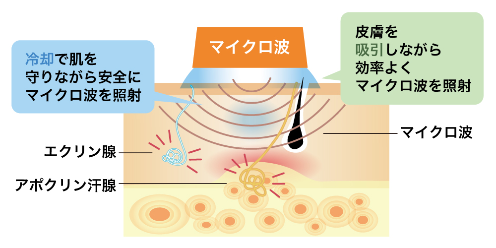 大阪・吹田でワキガ手術・わきが手術｜江坂駅前花ふさ皮ふ科・美容皮膚