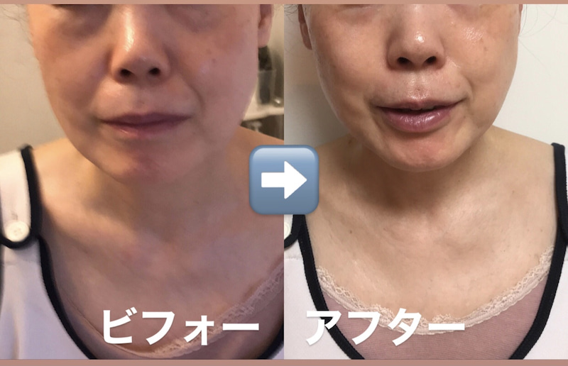 業務用ハイフ】フォーカスネオの効果は？ビフォー・アフターや口コミを