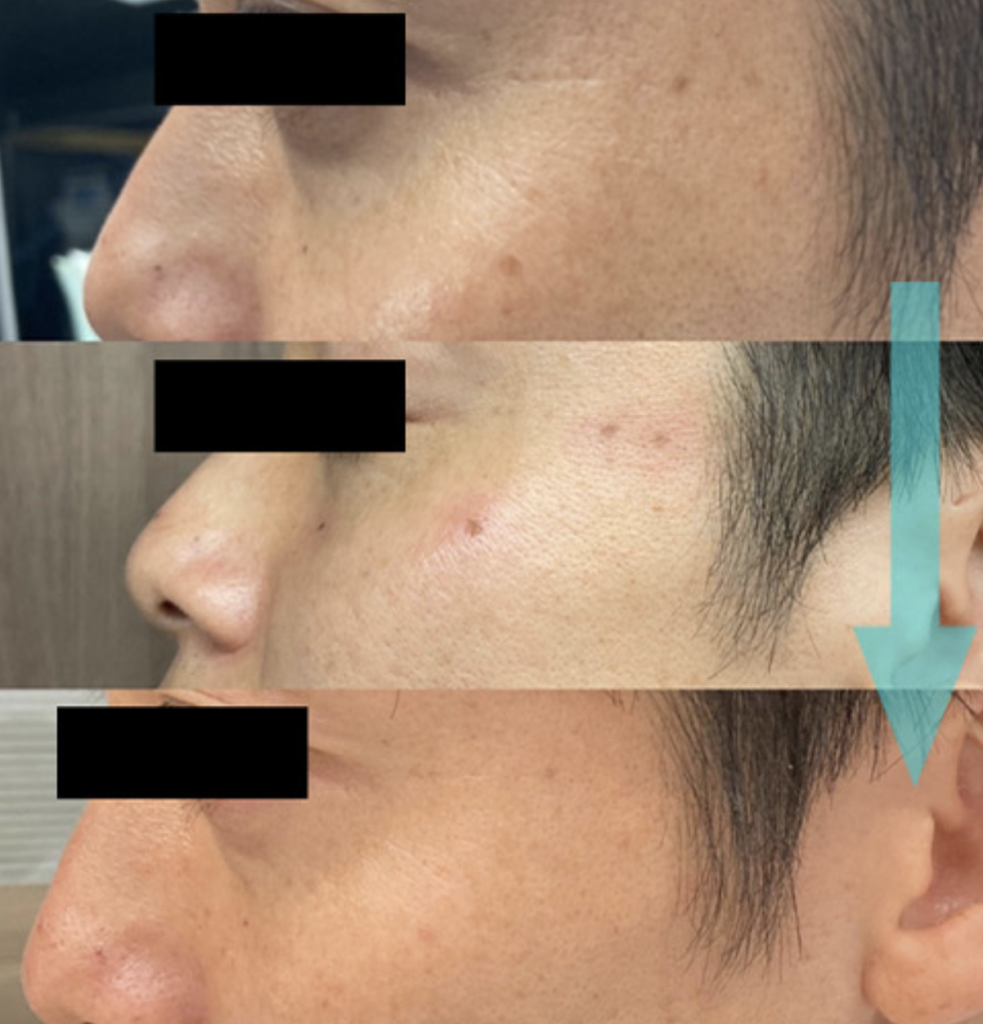 サロン導入可能なシミ取り機械を調査・比較してみました - 【公式