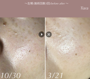 業務用シミ取り機器】オセロ｜特徴やマシン価格、サポート内容をご紹介