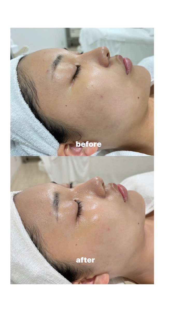 宮崎市エステ 毛穴洗浄 ダーマスクライバー | スタッフブログ | 熊本