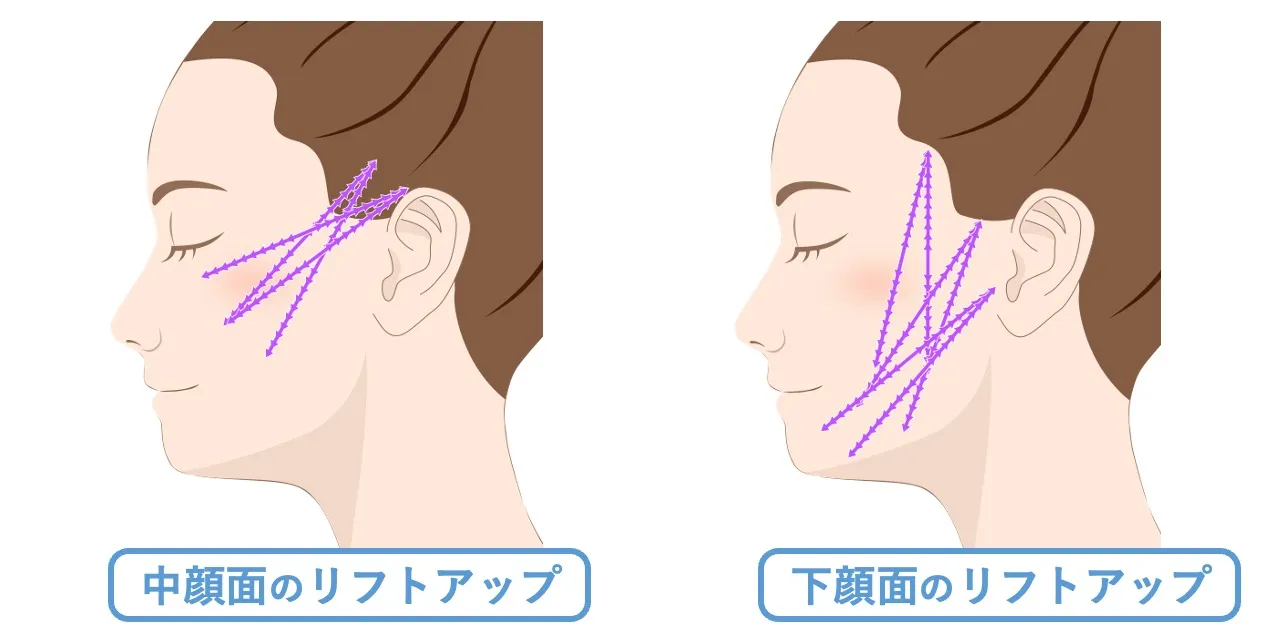 糸リフト】スレッドリフト｜仙台でたるみ治療を受けるならフェイス美容外科