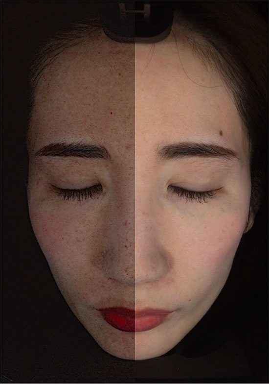 アクサフェイス | 業務用美容・エステ機器の卸・仕入通販は【ミヤタッチ】