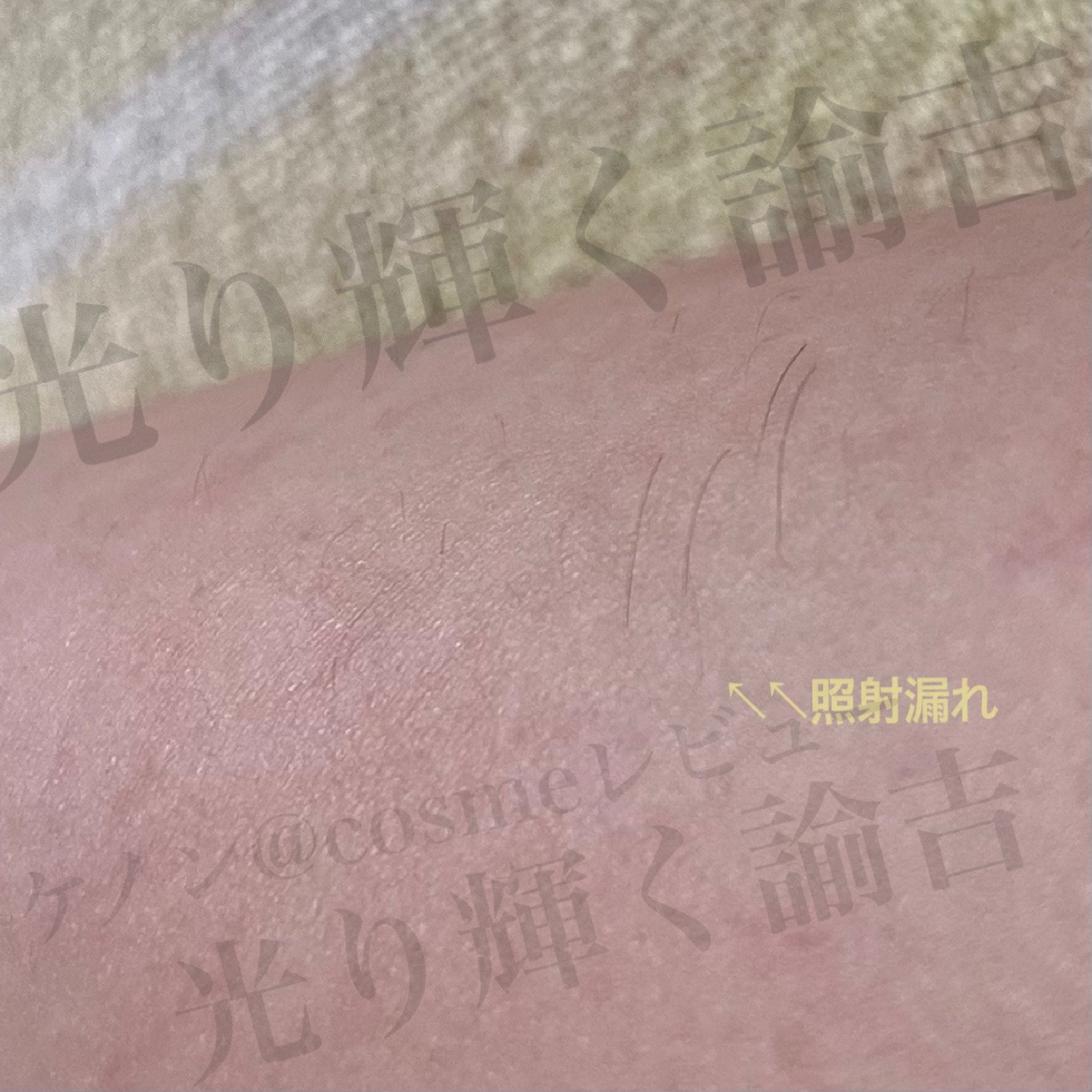 エムテック / 家庭用脱毛器 ケノン（ke-non）の口コミ（by 光り輝く