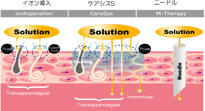 イオン導入・エレクトロポレーション | 美容皮膚科 | 各務原市・岐阜市