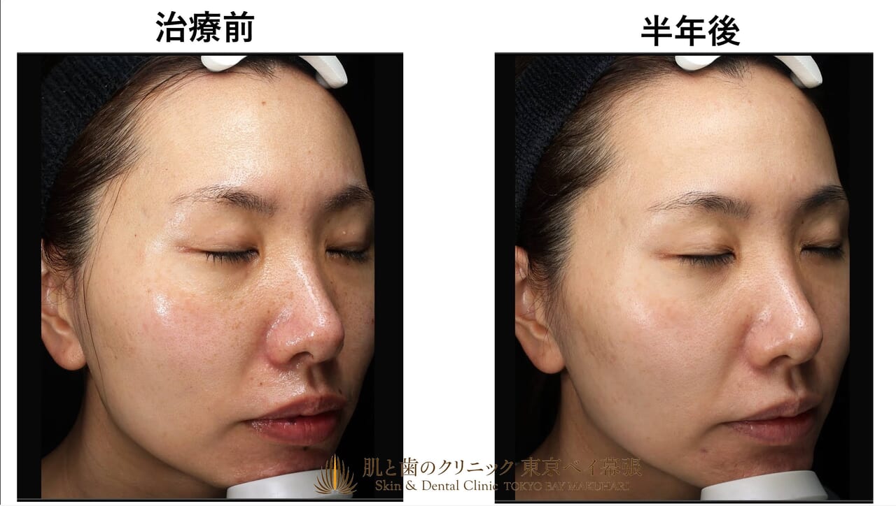 症例写真 | 顔の気になるシミとほくろをまとめて取る！シミほくろ半年
