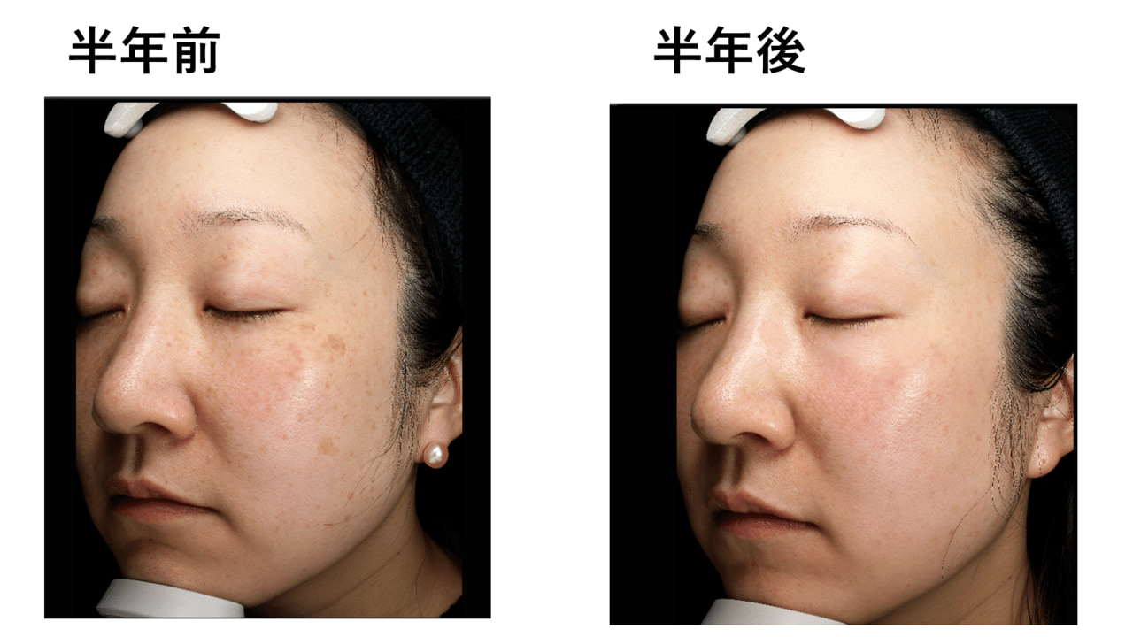 夏にできた日焼けシミ、この冬に一気に消しませんか？しみ半年コースが