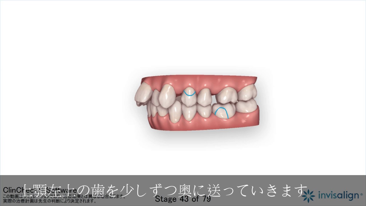 インビザライン・光加速矯正 - 【公式】沖縄の歯科矯正 おきなわ矯正歯科