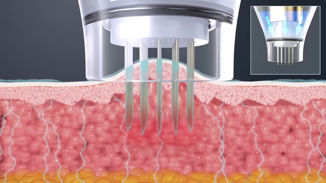 POTENZA(ポテンツァ）最新のマイクロニードルRFで肌質改善| 日本橋駅