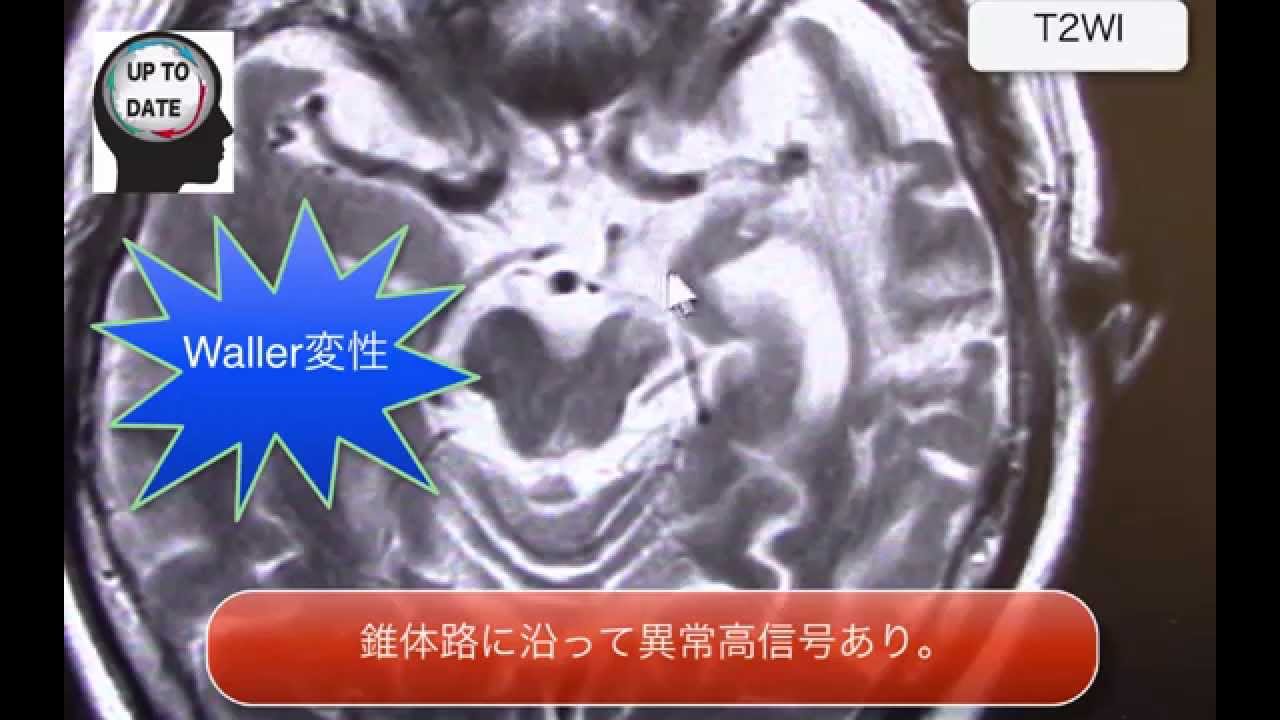 脳梗塞後に起こる合併症は？出血性梗塞とは？