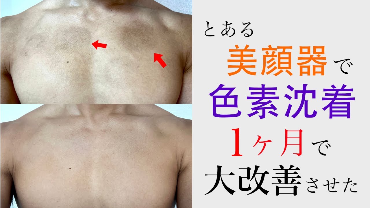 TRIA Skin Aging Care Laser] I was able to cure my severe