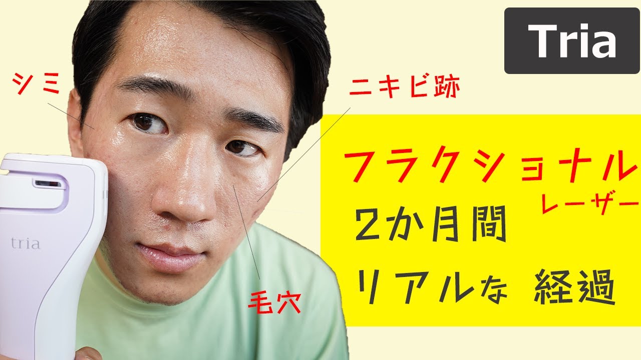 Tria Fractional Laser: Progress and Real Beauty Results After 2