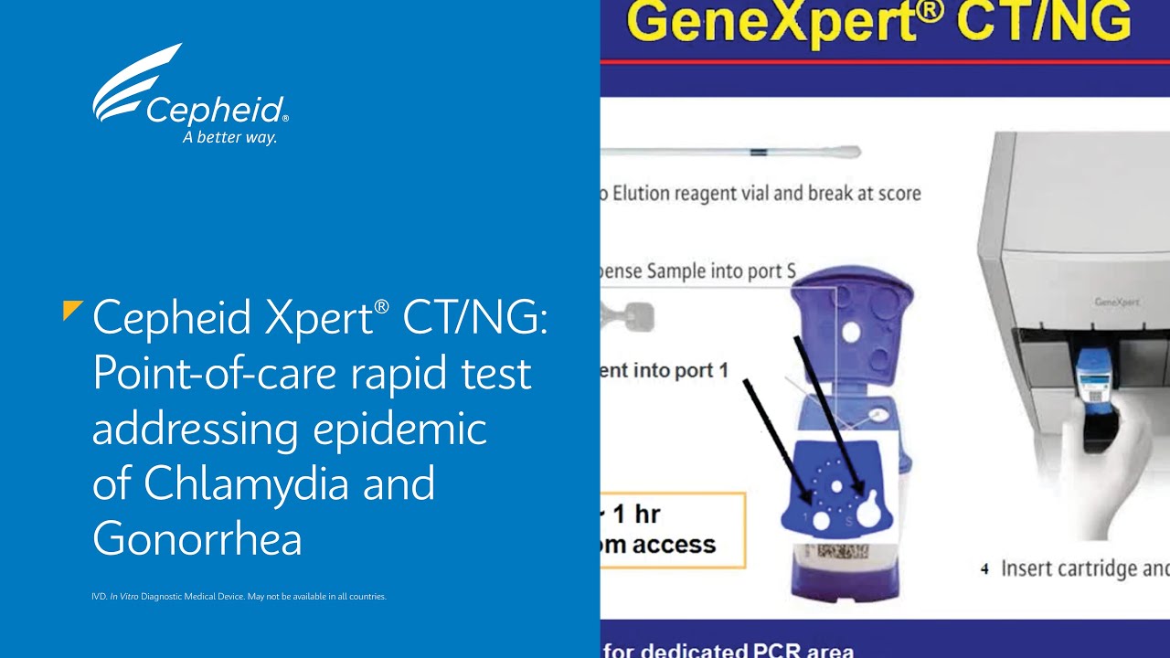 Cepheid Xpert® CT/NG: Point-of-care Rapid Test Addressing