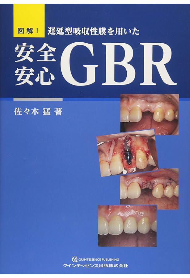 Amazon.co.jp: オープンバリアメンブレンテクニック: 低侵襲GBRの臨床
