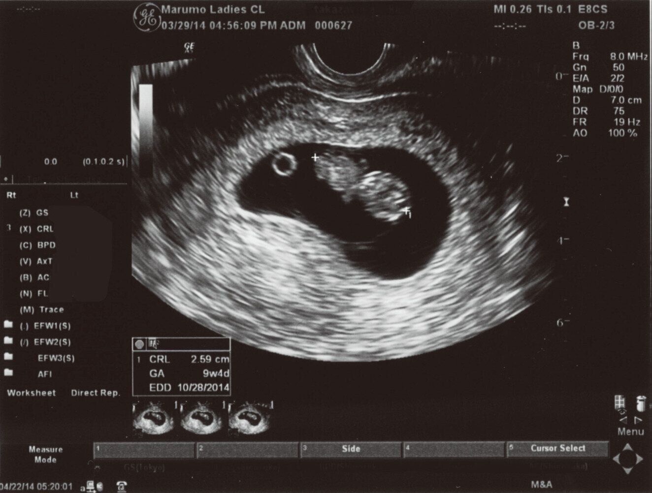 医師監修】産科医がビジュアルで解説します！「超音波写真（エコー写真