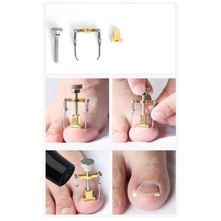 5個セット！矯正 器具 陥入爪 矯正 ネイルケア ツール ネイル