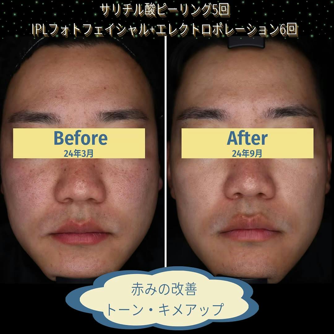 エレクトロポレーションができる美容クリニックの症例写真・ビフォー
