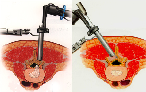 脊椎内視鏡・低侵襲手術 | KOMPAS – 慶應義塾大学病院 医療・健康情報