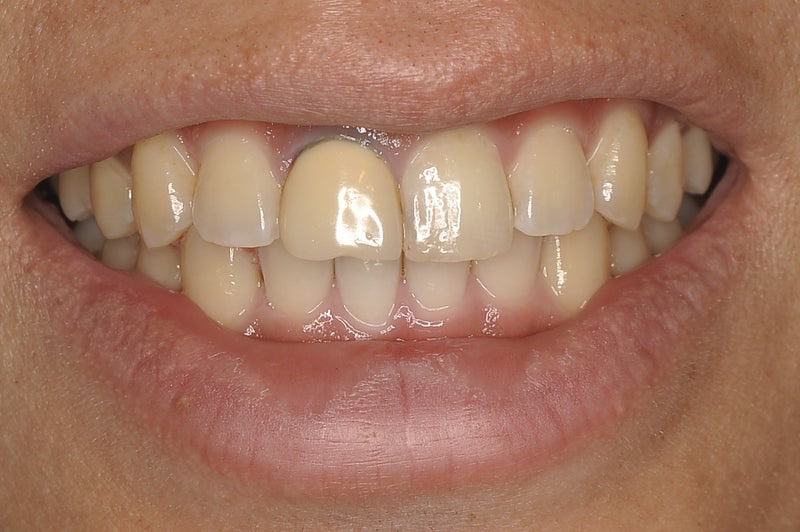 歯科恐怖症】【セラミック治療】あなたのセラミックの土台は大丈夫