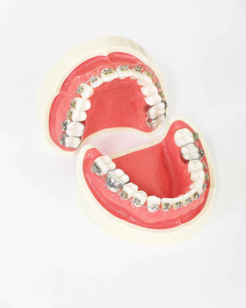 身体への負担は最小限！反対咬合の悩み・原因・治療は「重心矯正 」で