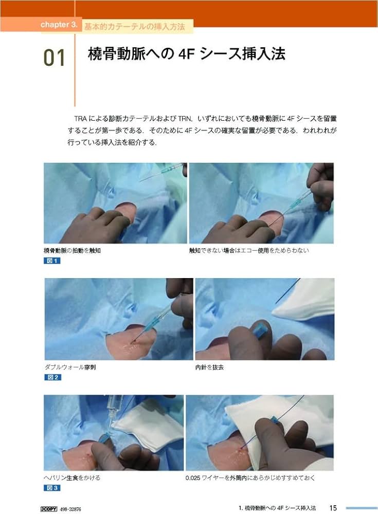 脳血管内治療医のための経橈骨動脈治療テクニカルガイド 400症例から