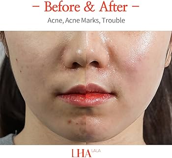 Amazon.co.jp: LHA LALA Peel Set Basic & Ultra ララ ピール