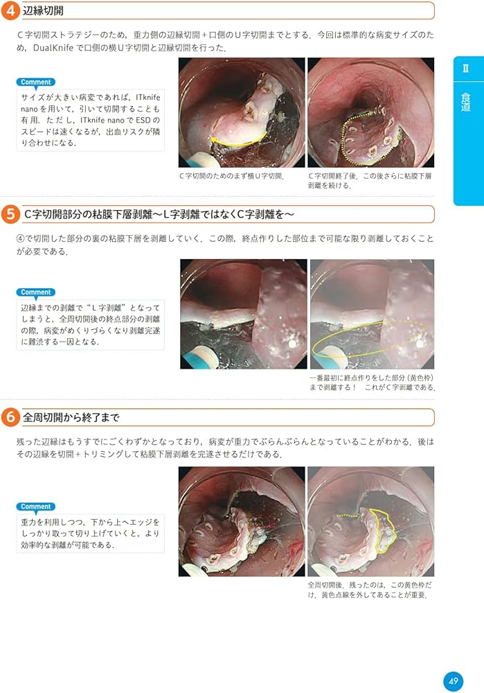 ザ・テキスト 食道・胃・十二指腸ESD | 大圃 研, 千葉 秀幸 |本 | 通販