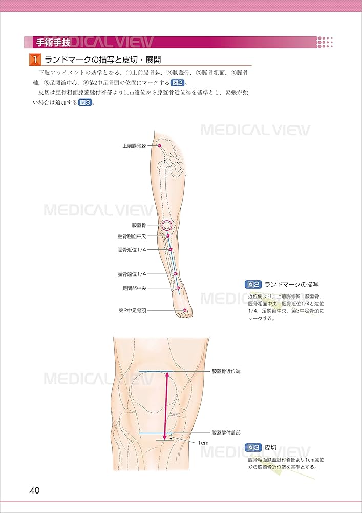 Amazon.co.jp: 膝関節の再建法−最適な選択のために (OS NEXUS(電子版