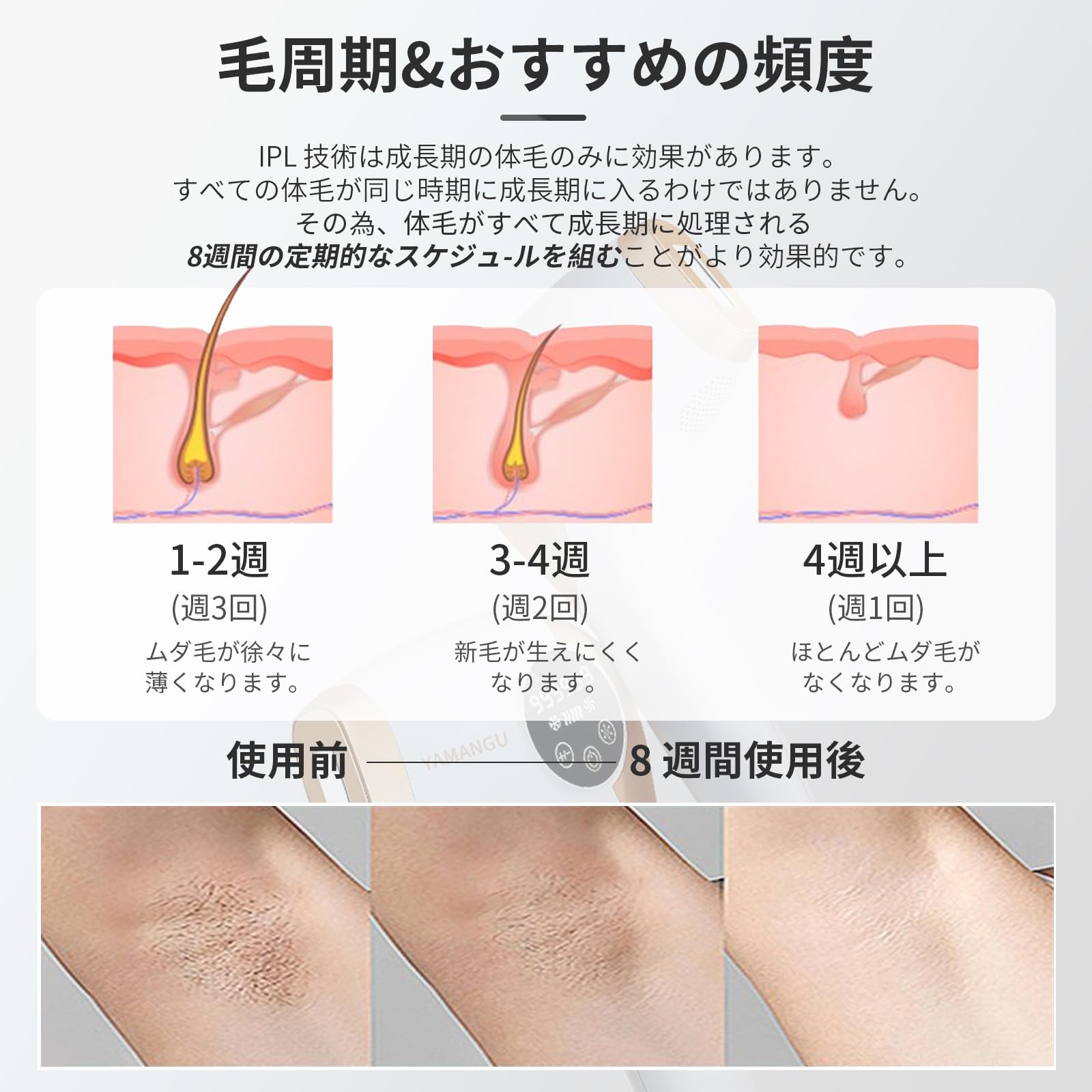 Amazon | YAMANGU 脱毛器 低温サファイア冷感脱毛 レディース メンズ