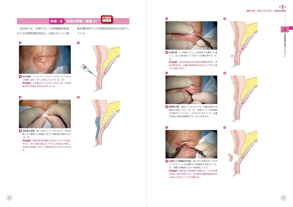 動画＆イラスト＆写真でわかる眼瞼手術の極意 advance：誰でも