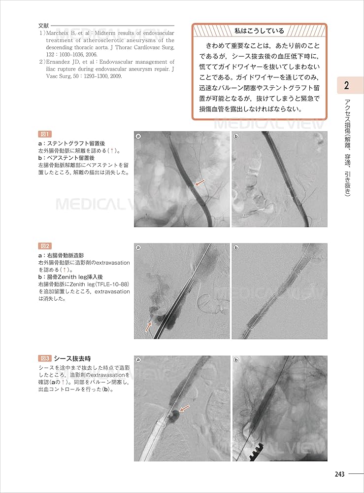 ステントグラフトの大技・小技−胸腹部大動脈瘤へのワンランクアップの