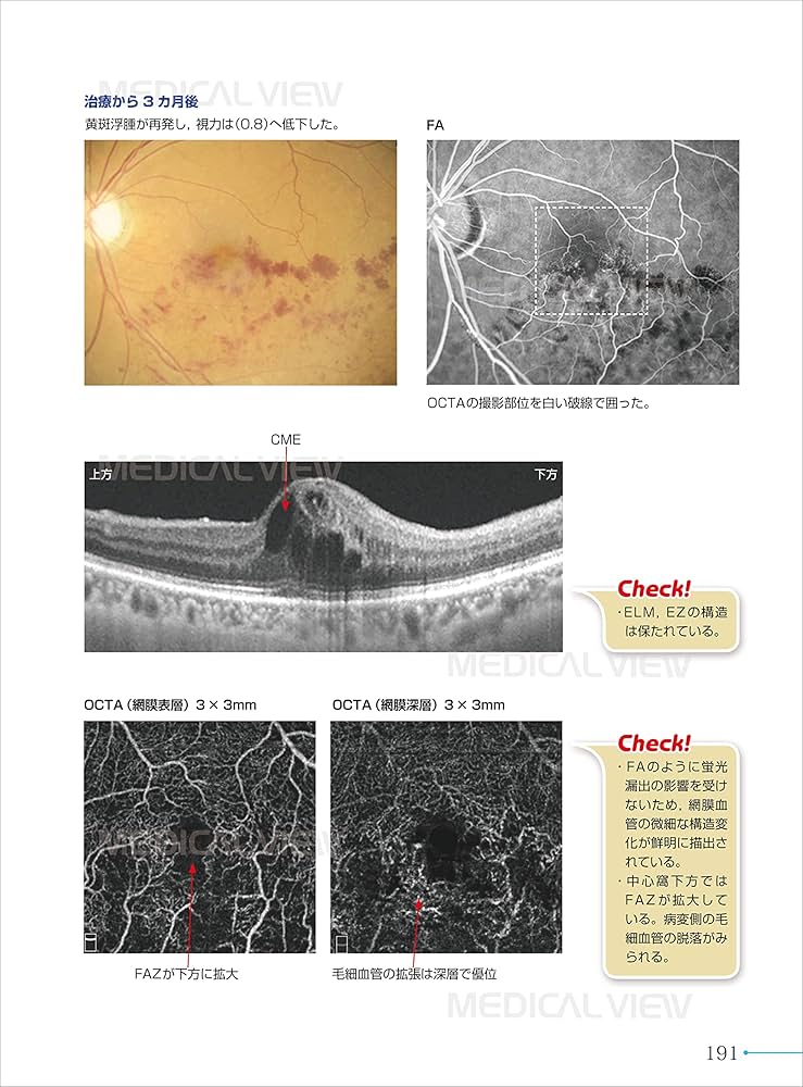 新OCT・OCTA読影トレーニング | 白神 史雄, 飯田 知弘 |本 | 通販 | Amazon