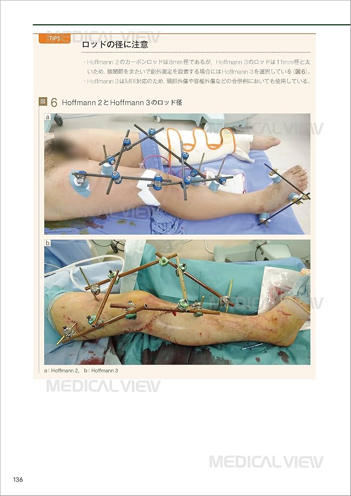 一時的創外固定マニュアル : Amazon.com.au: Books